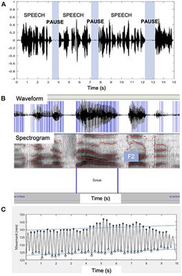 Two Distinct Clinical Phenotypes of Bulbar Motor Impairment in Amyotrophic Lateral Sclerosis